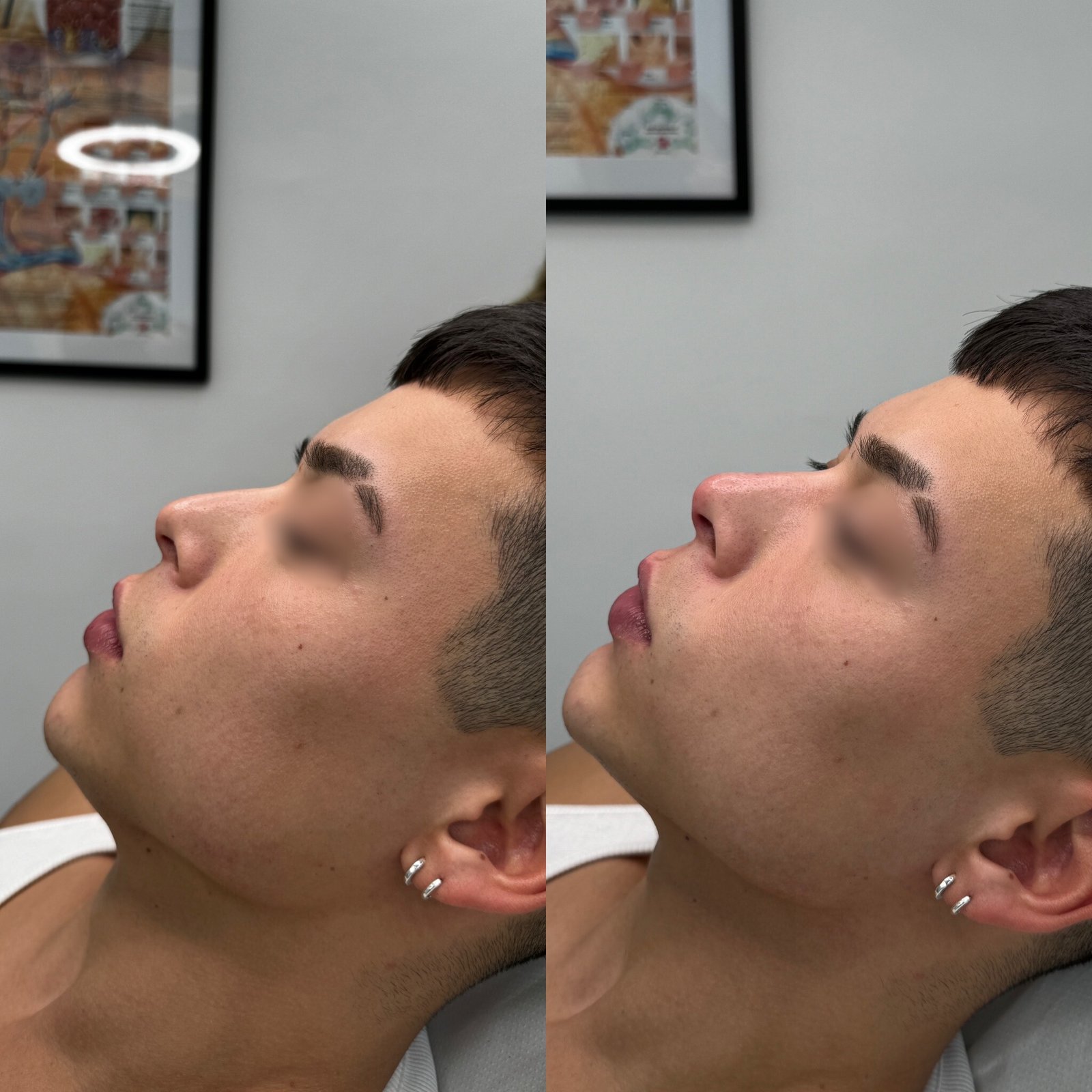 best-non-surgical-rhinoplasty-treatment-in-london-finsbury-clinic