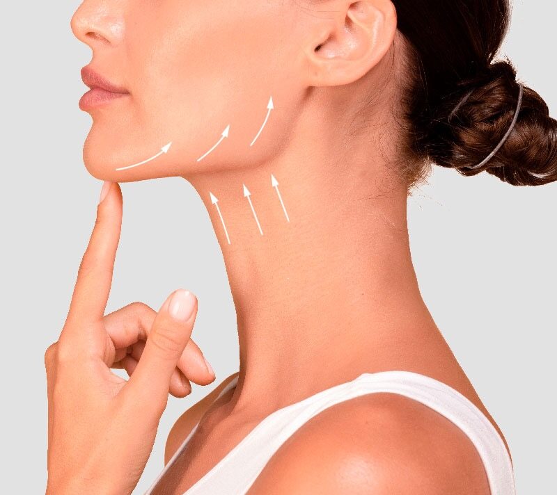 Jawline Lift